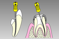 歯内療法