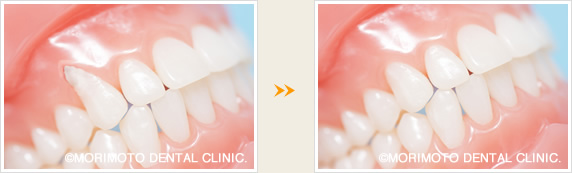 歯ぐき移植のイメージ
