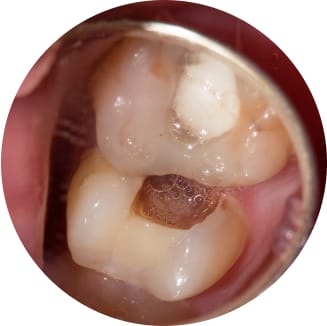 深い虫歯・根管治療